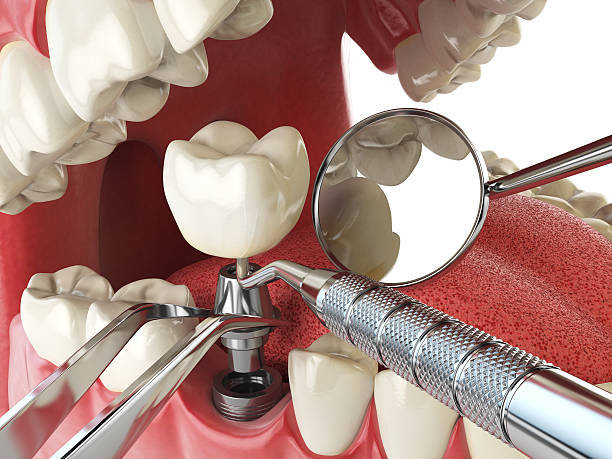 Best Dental Abscess Treatment in Fern Prairie, WA